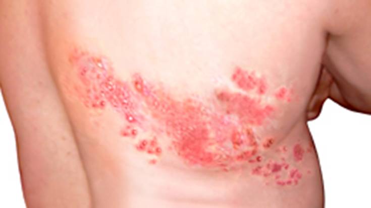 Zoster herpesaren kontra babesteko gomendioak eman ditu Lesakako Osasun Zentroak